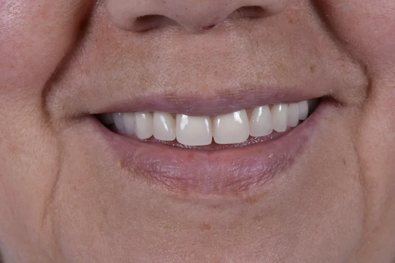Dental implants and All-on-4 case, Oral Synergy Cuenca