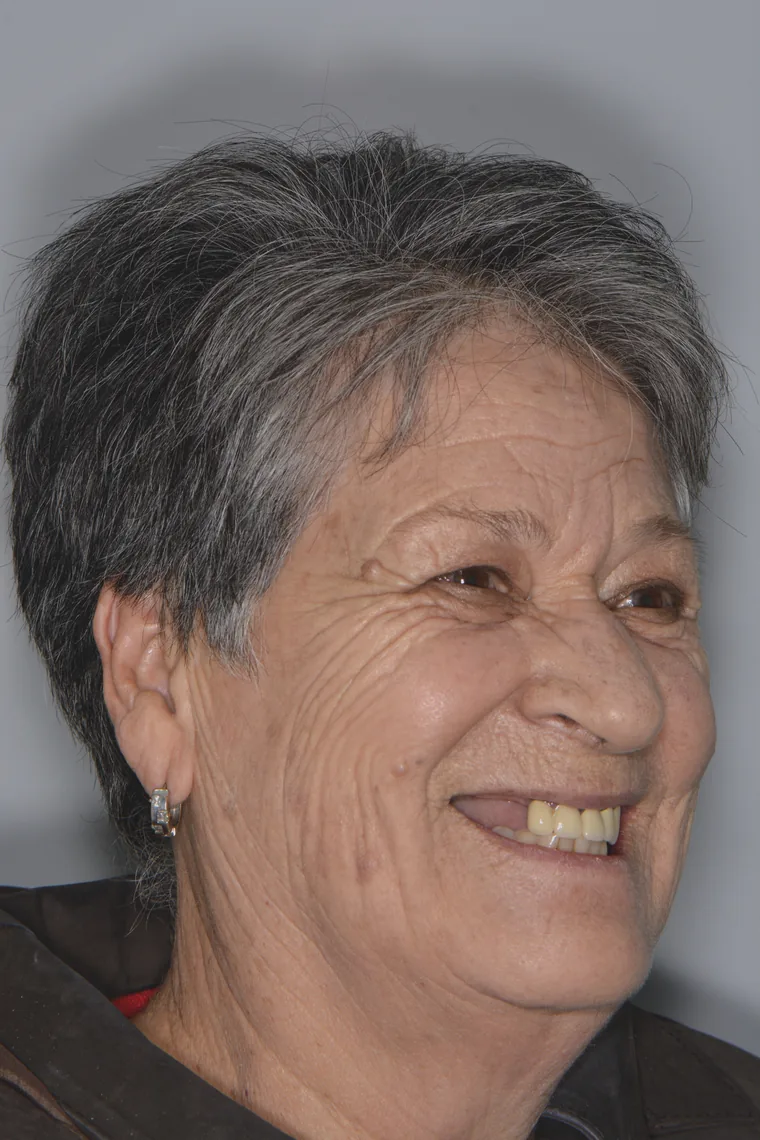 Dental implants and fixed prosthesis patient before treatment at Oral Synergy Cuenca