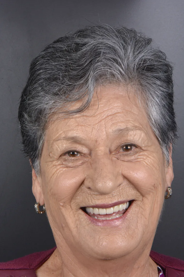 Dental implants and fixed prosthesis patient after treatment at Oral Synergy Cuenca