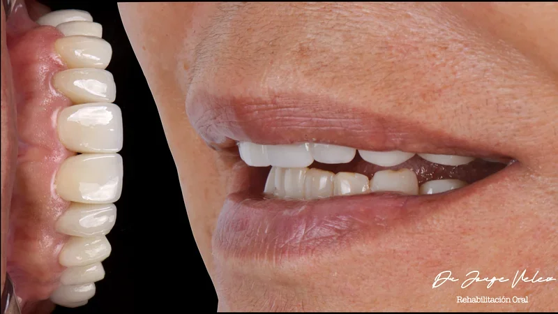 Full-mouth rehabilitation case by Dr. Velez, Oral Synergy Cuenca