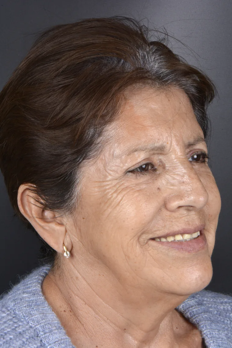 Full-mouth rehabilitation patient before treatment at Oral Synergy Cuenca
