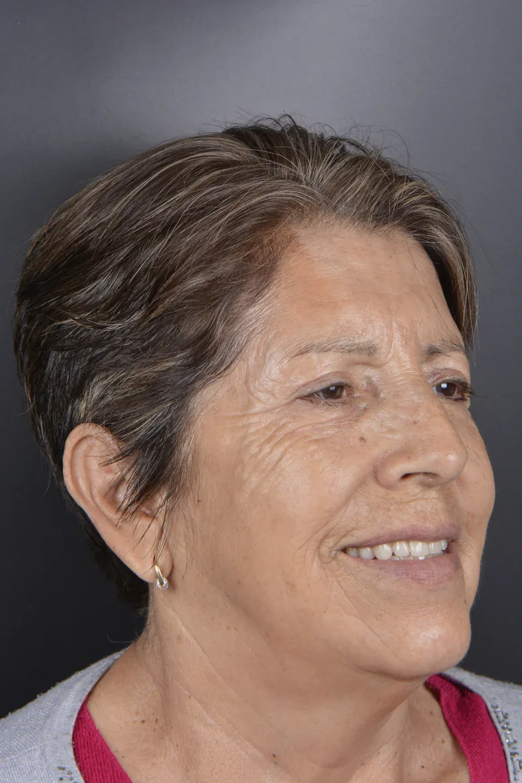 Full-mouth rehabilitation patient after treatment at Oral Synergy Cuenca