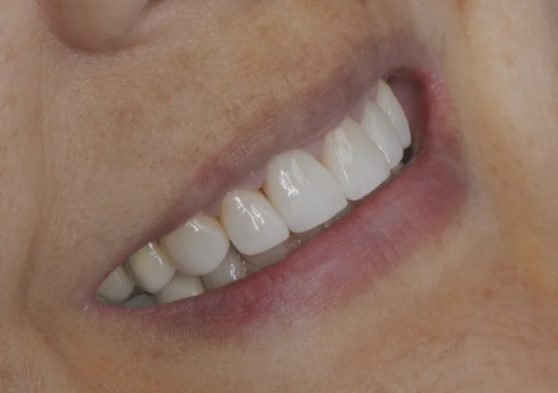 Ceramic veneers smile design case, Oral Synergy Cuenca
